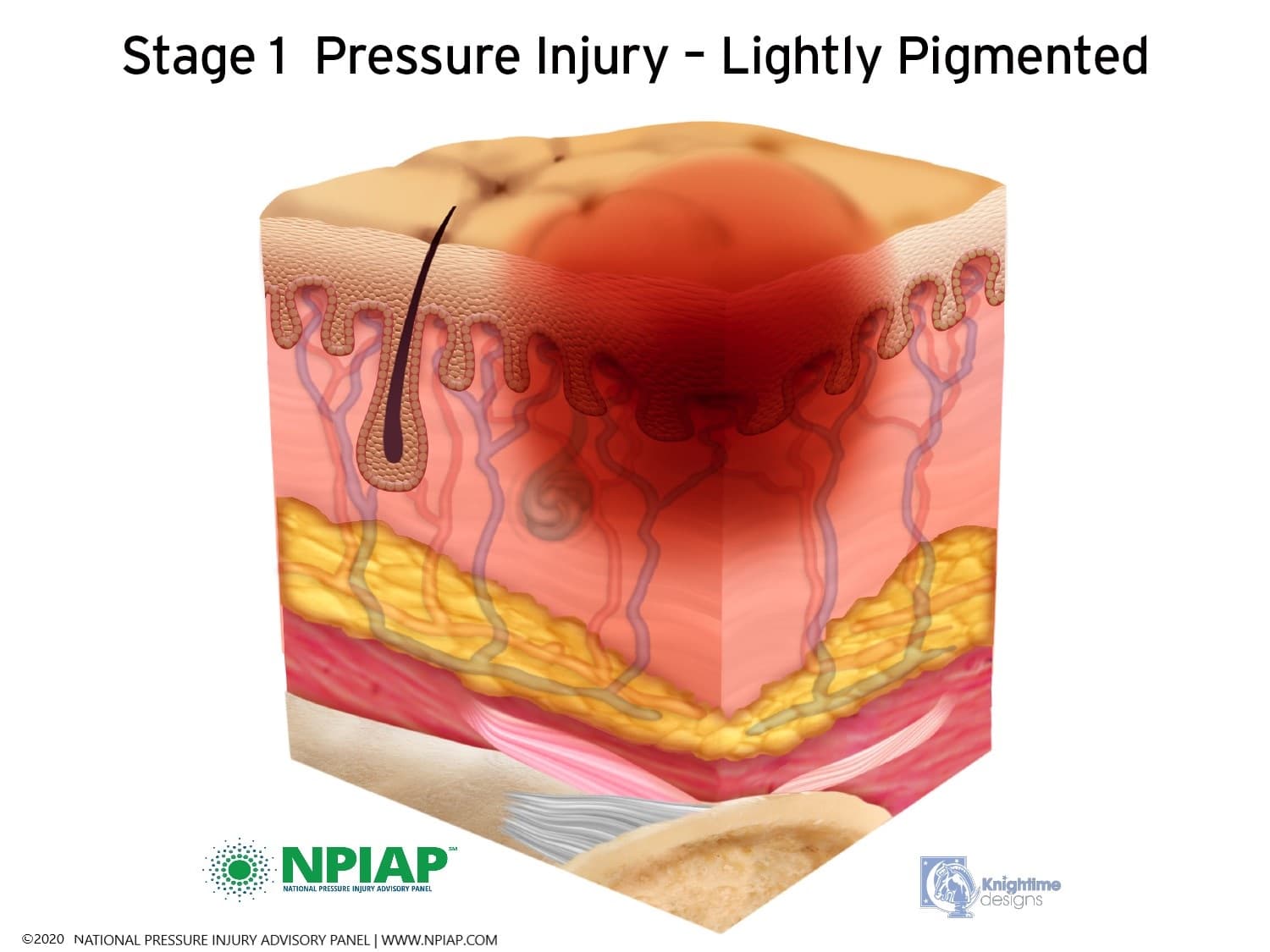 Nutrition And Healing Wounds The Geriatric Dietitian