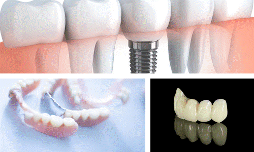 implants and partials