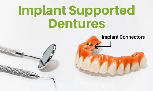 implant supported dentures overdentures