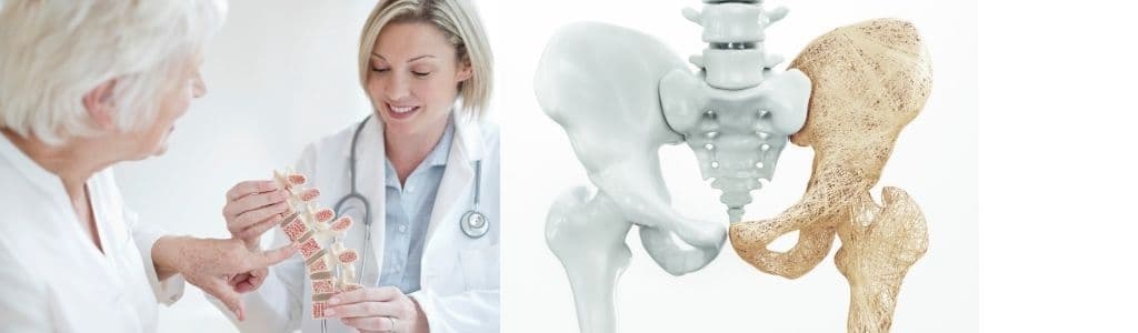 Osteoporosis in the Elderly