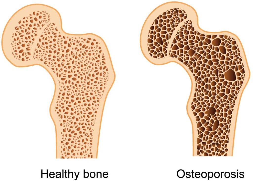 osteoporosis