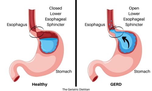 Healthy vs GERD Stomach