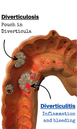 Colon - Diverticulosis vs Diverticulitis.